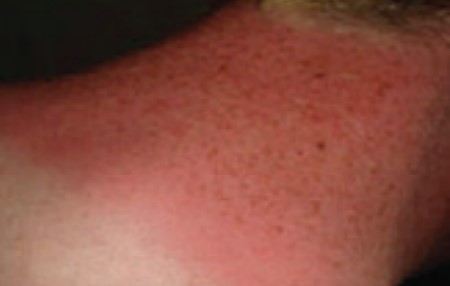 Sun Burn